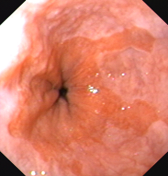 Foto endoscopica di Esofago di Barrett. E’ bene evidente il tessuto con colorito rosa salmone che costituisce l’esofago di Barrett, in contrasto con il rosa pallido dell’epitelio esofageo