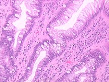 Foto di metaplasia intestinale al microscopio