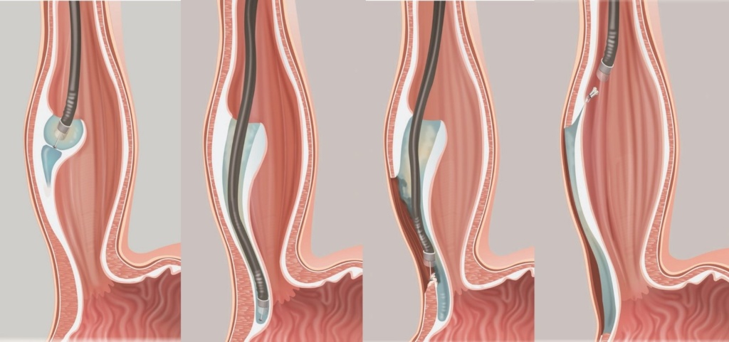 Procedura di Miotomia Esofagea Transorale (POEM). Da Inoue H et al. Endoscopy 2010;42:265-171 