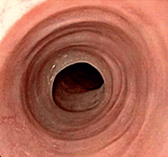Aspetto endoscopico con anelli, tipico della esofagite eosinofila
