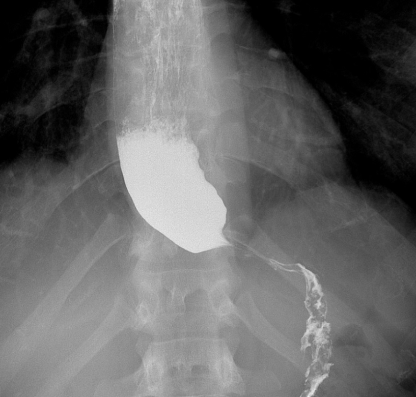 Immagine radiografica di un paziente con acalasia. E’ bene evidente l’esofago dilatato