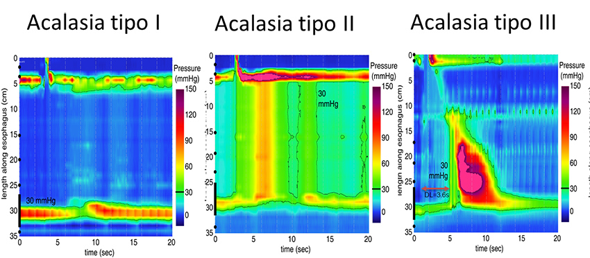 Figura 2. Tipi di acalasia esofagea alla manometria esofagea ad alta risoluzione in base alla Classificazione di Chicago. Nell’acalasia di tipo I vi è una totale assenza di movimento (aperistalsi), nella tipo II si evidenziano delle onde incoordinate lungo tutto il viscere (pressurizzazioni panesofagee), mentre nella tipo III si osservano delle contrazioni vigorose e premature. 
